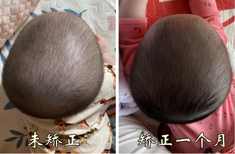 宝宝头部矫正对比
