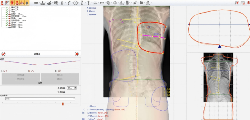 使用 Rodin 4D三维建模脊柱矫形支具